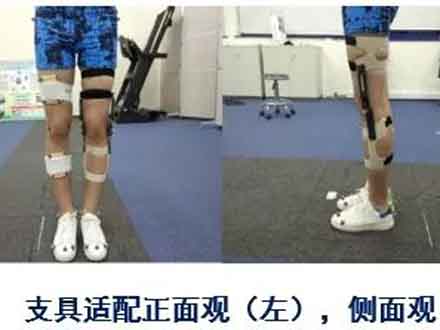 3D打印个性化膝关节矫形器