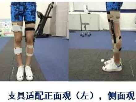 3D打印个性化膝关节矫形器