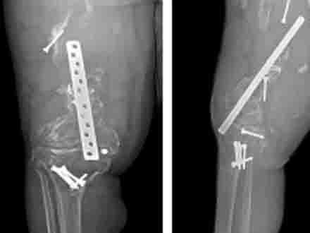 用3D打印技术为骨包虫病患者实施一期全髋+全股骨+全膝置换手术