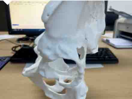 3D打印助力复杂髋关节翻修：在“废墟”上重建新关节