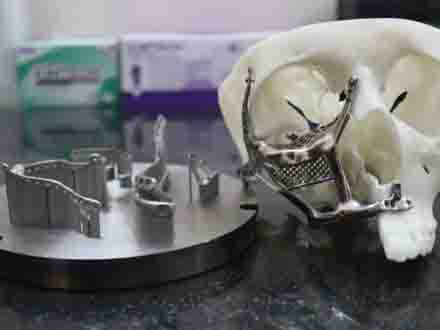 金属3D打印面部植入物帮助黑真菌患者恢复面容